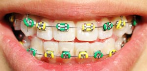 metal braces in Reno