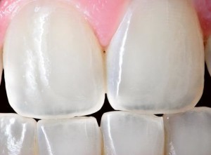 worn tooth enamel