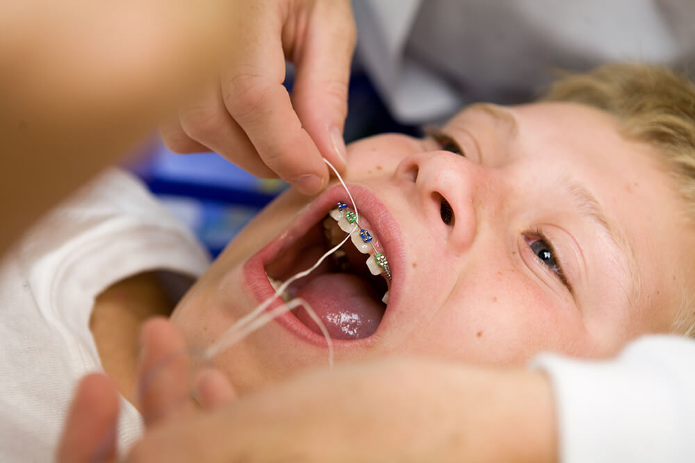 Child getting teeth cleaned with braces