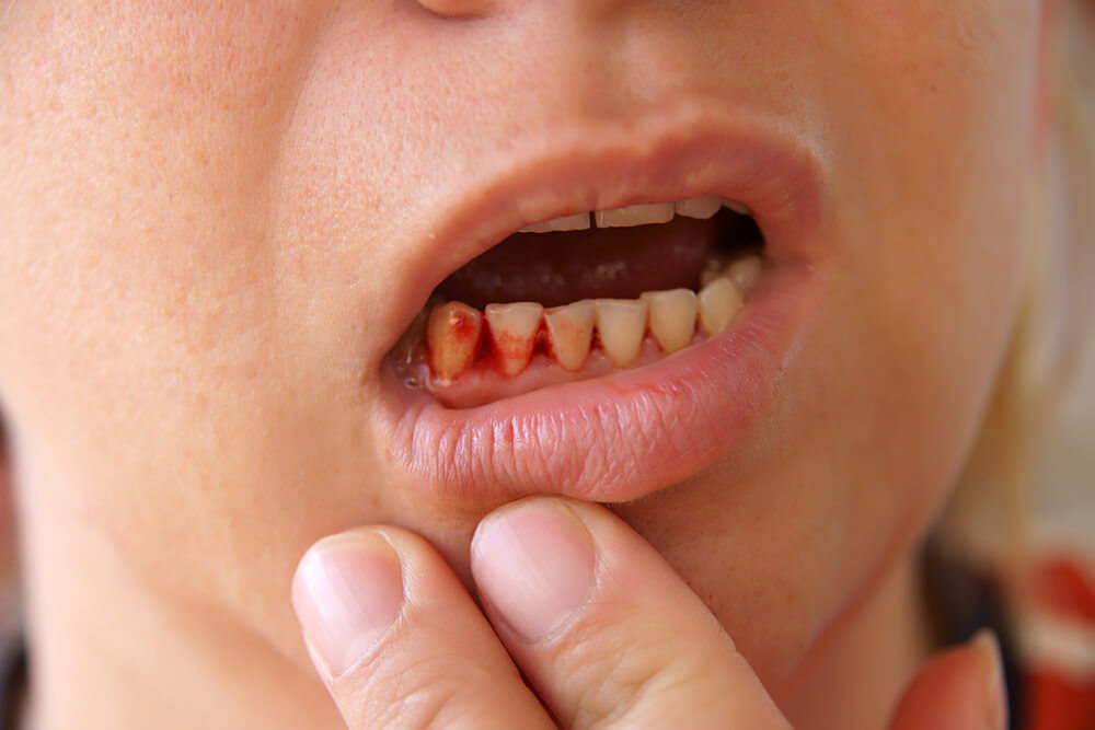 Why Are My Gums Bleeding? | Absolute Dental