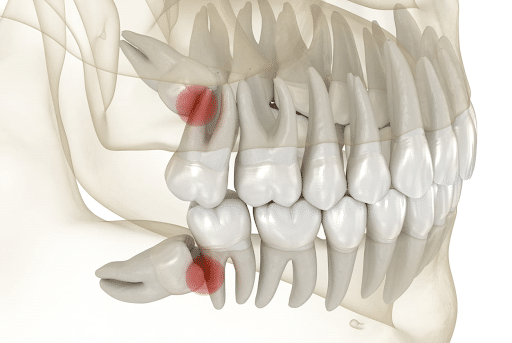 An illustration of impacted wisdom teeth causing pain to the other molars.