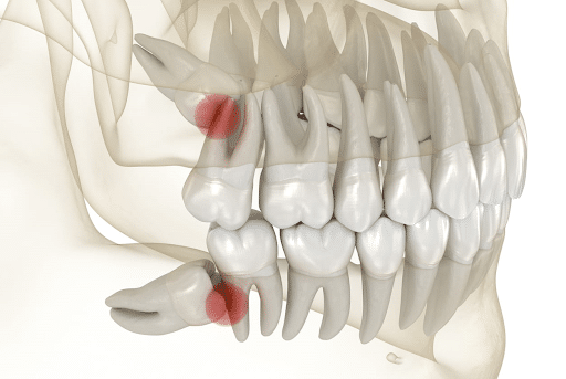 wisdom teeth before and after