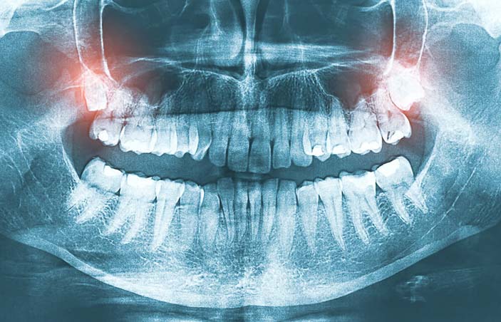 Things about Wisdom Teeth Surgery