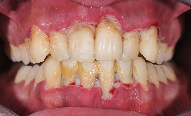 infected gums