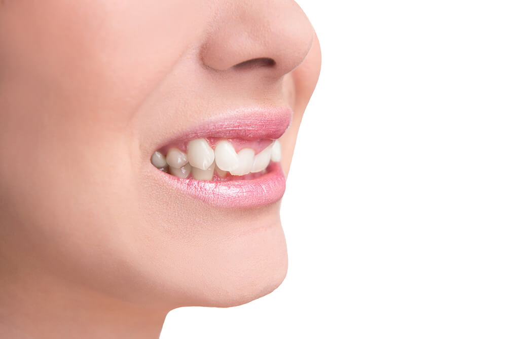 The Modern Approach to Overbite Correction with Invisalign