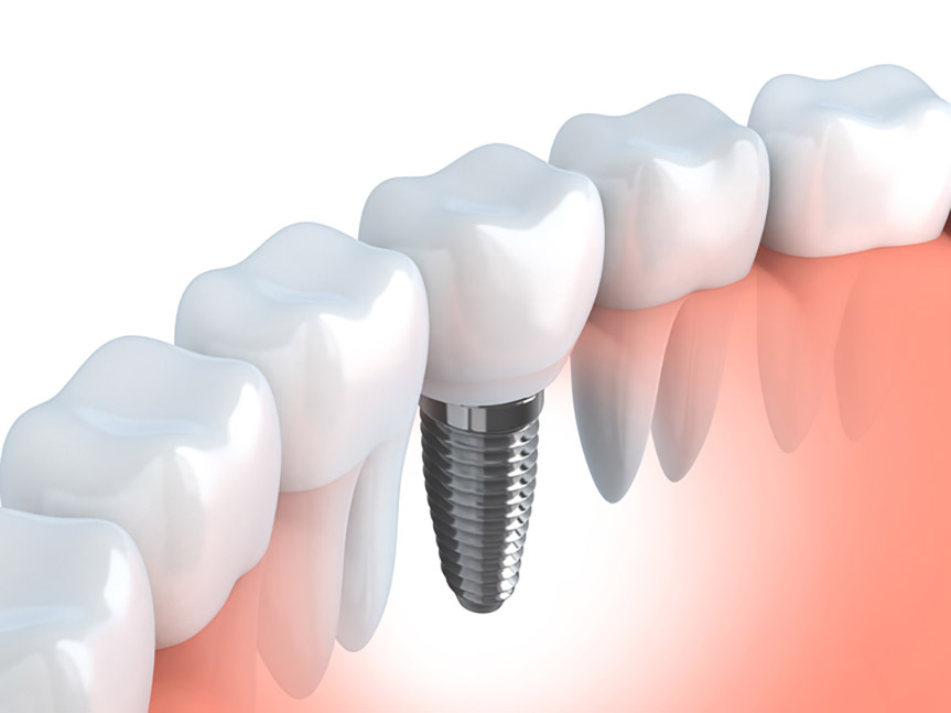Dental implants when inside the mouth