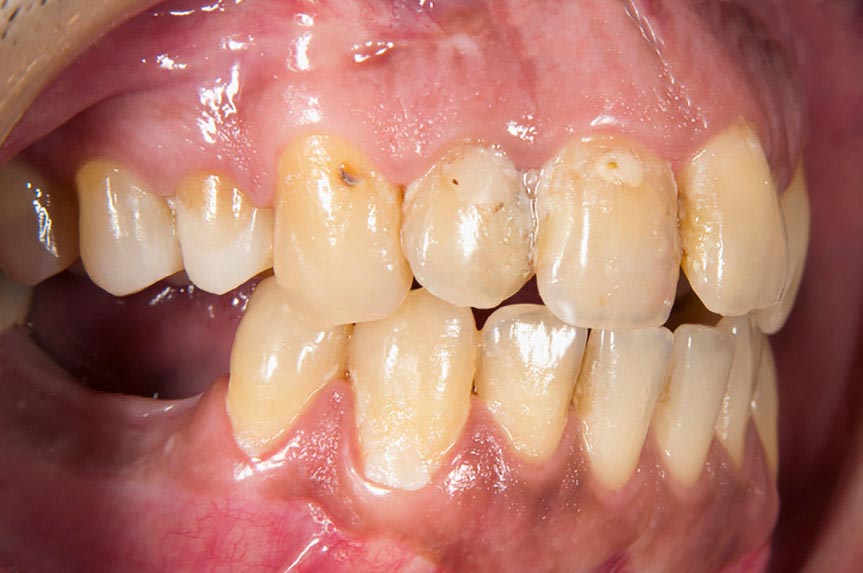 Gum disease (periodontitis)