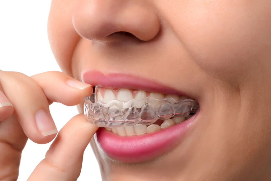 Pros and Cons of Invisalign Braces | Absolute Dental
