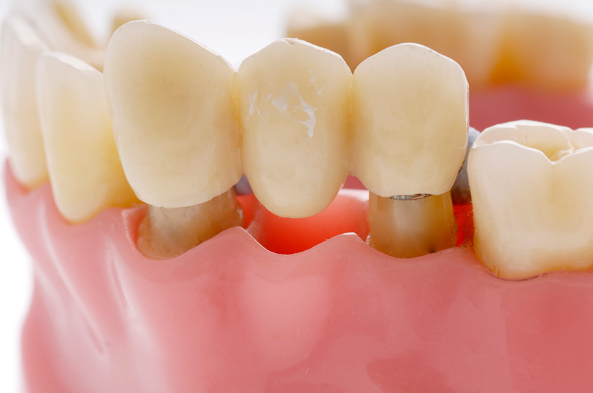 Dental bridge
