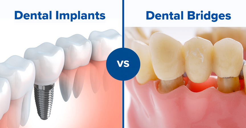 Are Dental Implants Better Than Bridges?