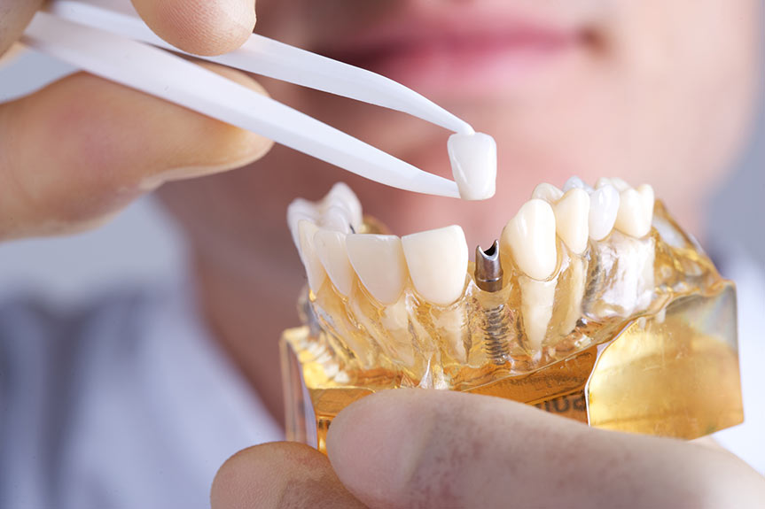 how to avoid potential dental implant complication
