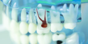Root canals in las vegas