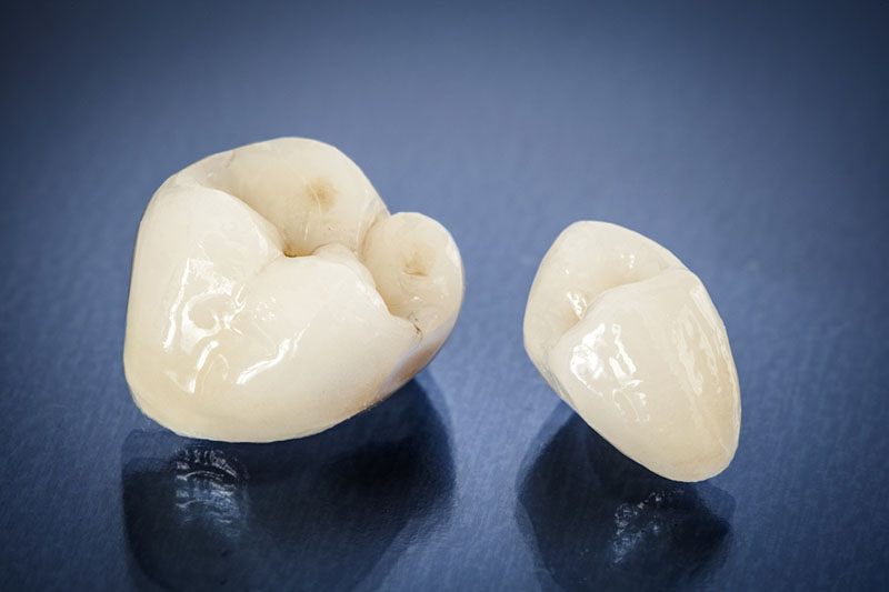 Different types of dental crowns