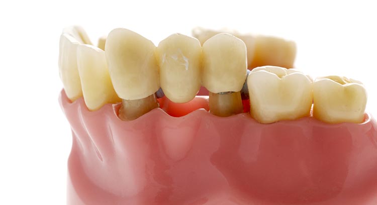 What are Dental Bridges?