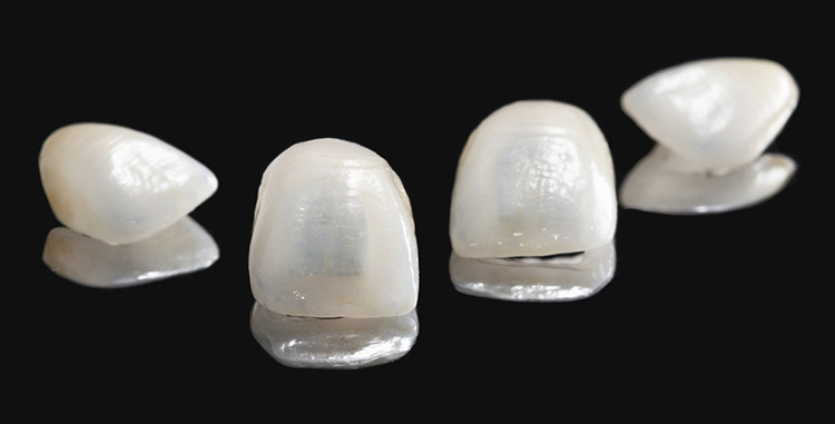 Temporary Teeth Veneers - 3 Sizes, 12 Positions, SL Ceramic For Anterior Whitening