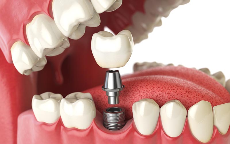 How Dental Implants Help With Bone Loss 3 Dental implant concept