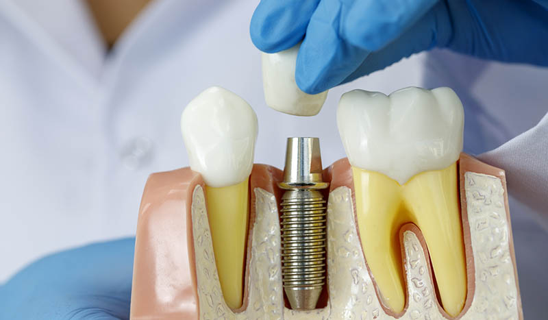 dentist showing model of dental implant