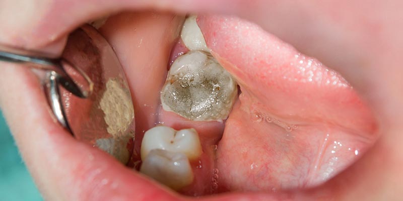 dentist examining dead tooth