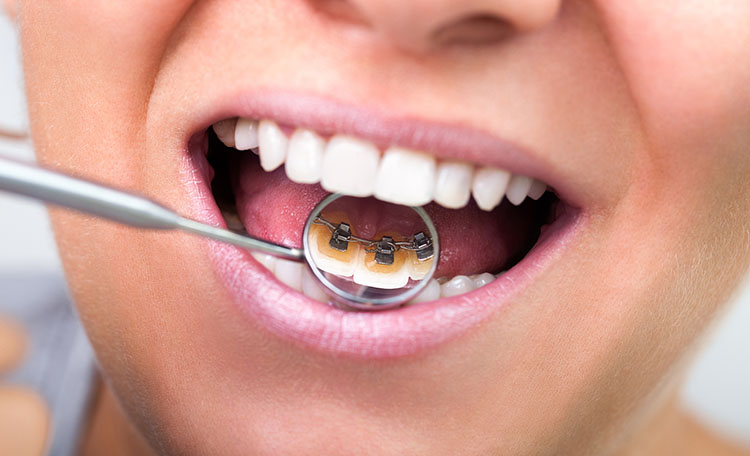 Woman with lingual braces