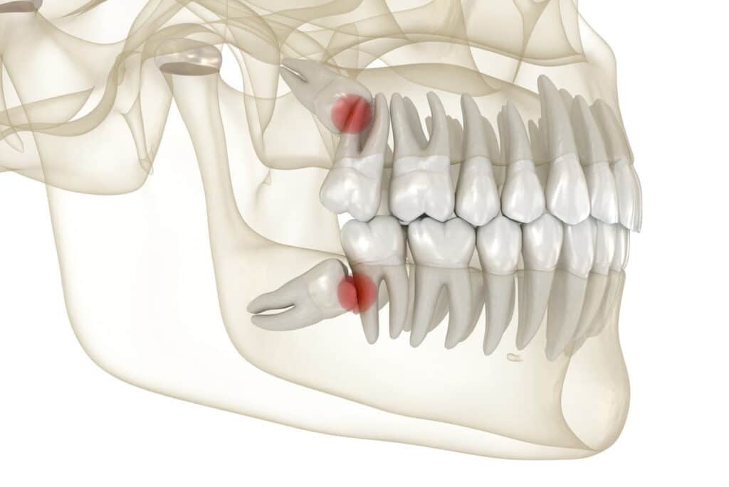 Medically accurate 3D illustration of mesial impaction of wisdom teeth to the second molar.