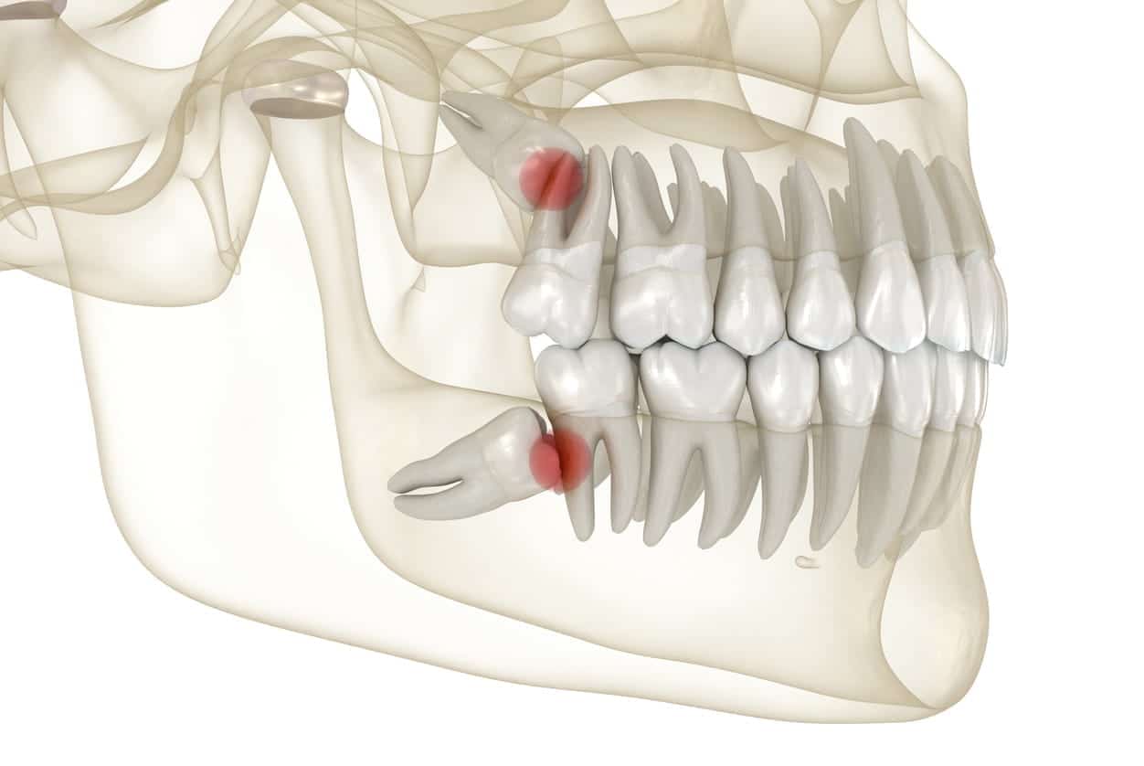 Learn What Will Happen if Wisdom Teeth are Not Removed