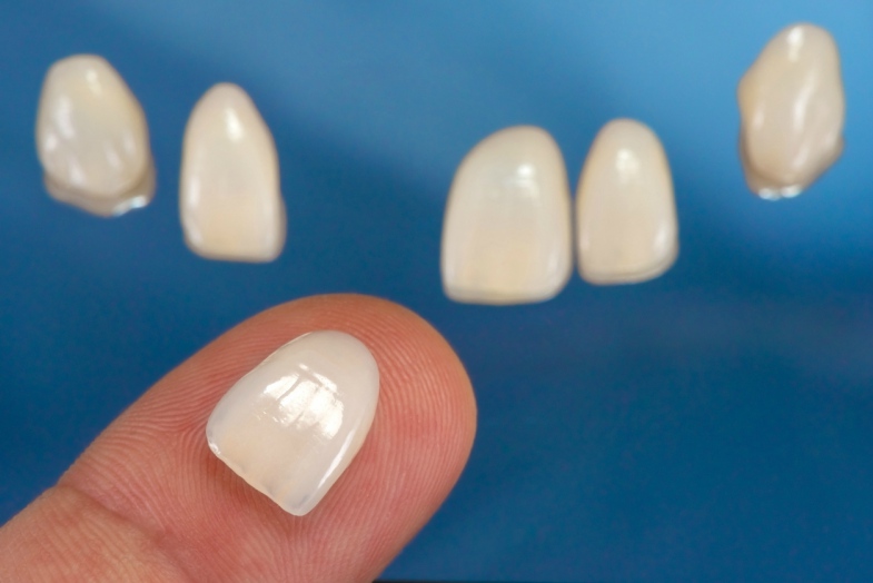 Thinner Porcelain Veneers