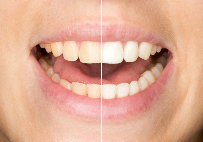 Teeth whitening before and after