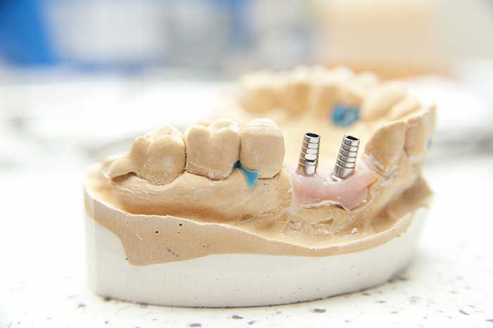 Dental implant model 