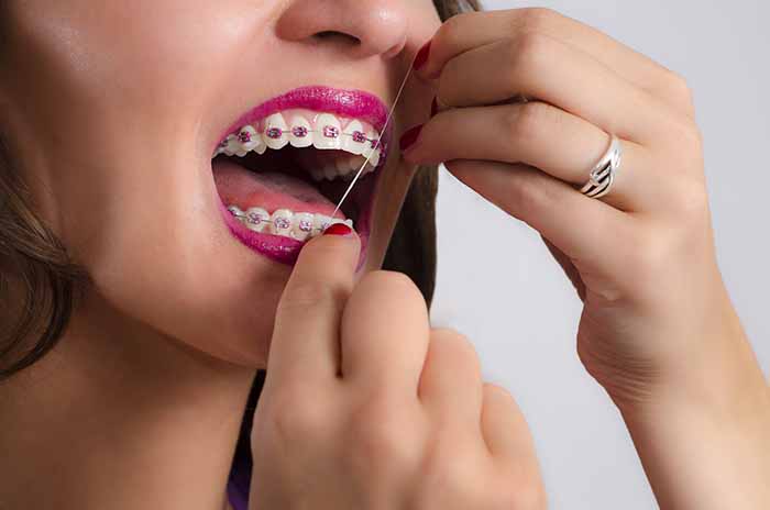 Flossing with braces