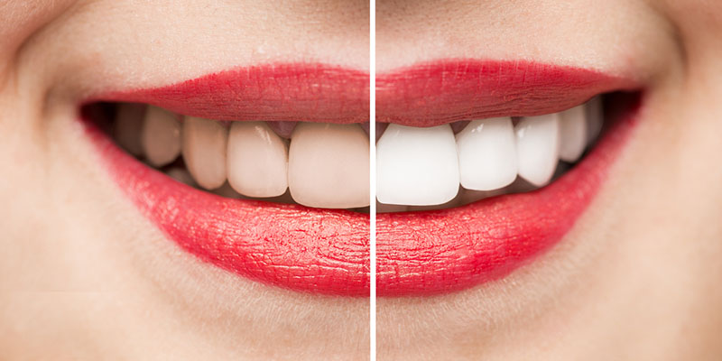 Teeth whitening before and after results