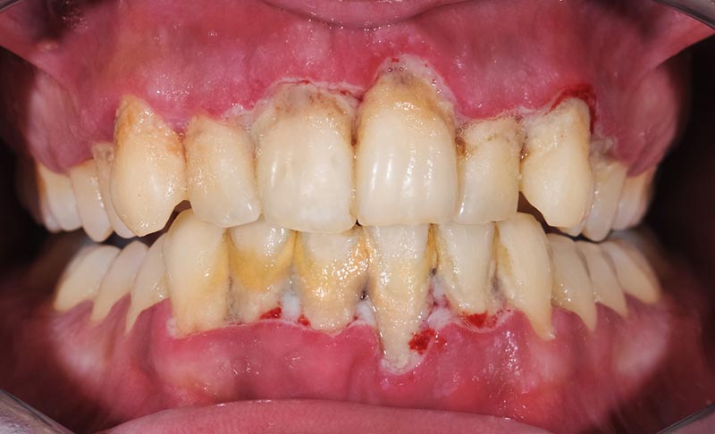 patient with periodontal disease