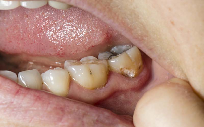 patient with tooth decay