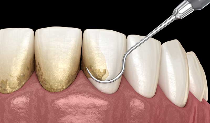 Dental tool removing tartar and plaque