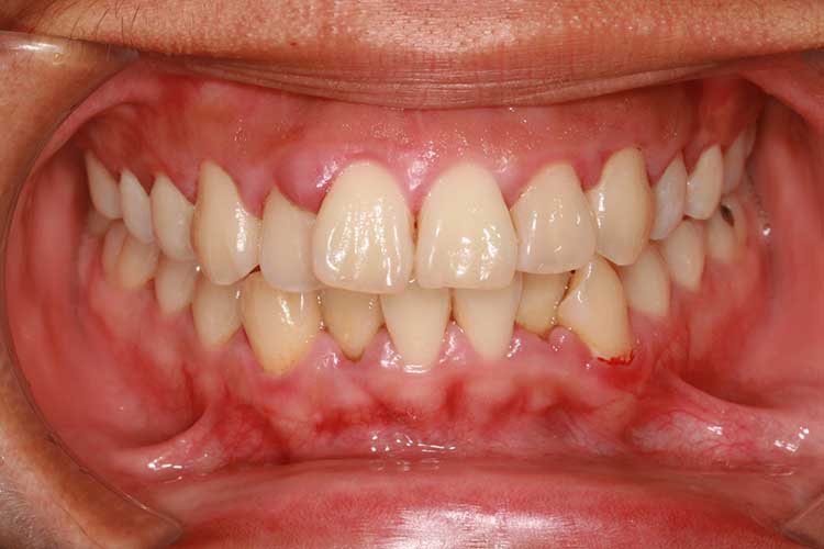 gums with gingivitis