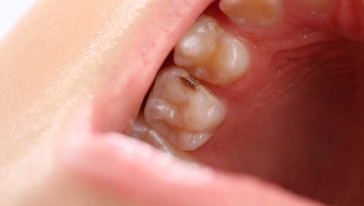 Signs of tooth cavity