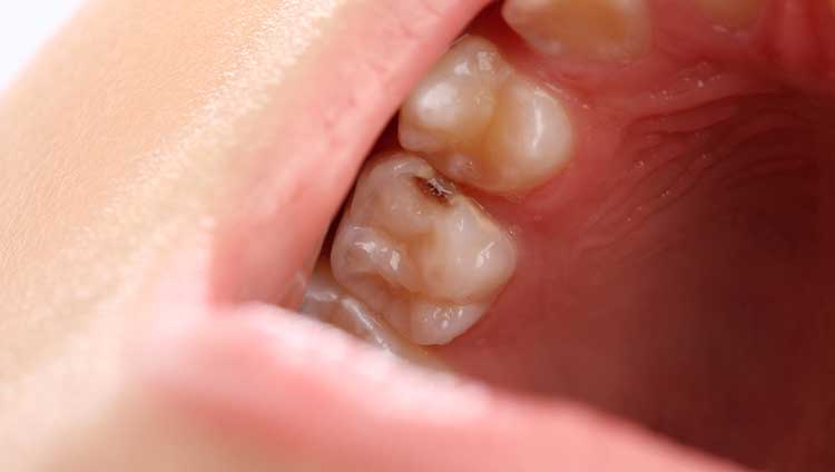 Molar shop tooth decay