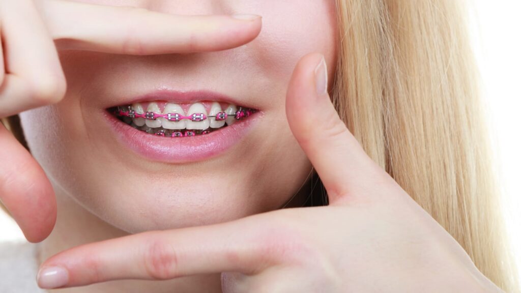 A woman frames her mouth and jaw with her hands to focus on her pink braces.