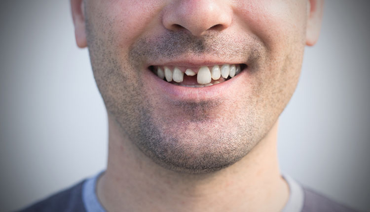 What to Do If You Chipped or Broke a Tooth | Absolute Dental