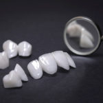 Porcelain veneers