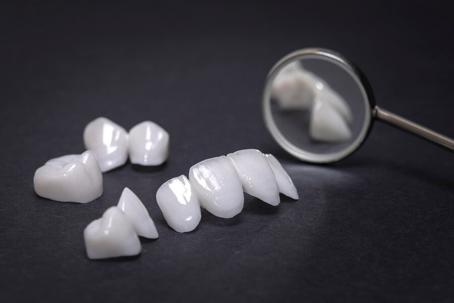 Porcelain veneers