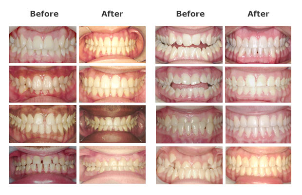 Before and after braces