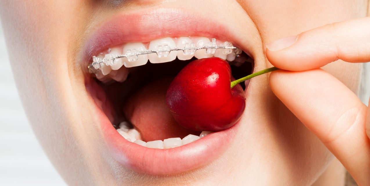 woman with clear braces from Absolute Dental