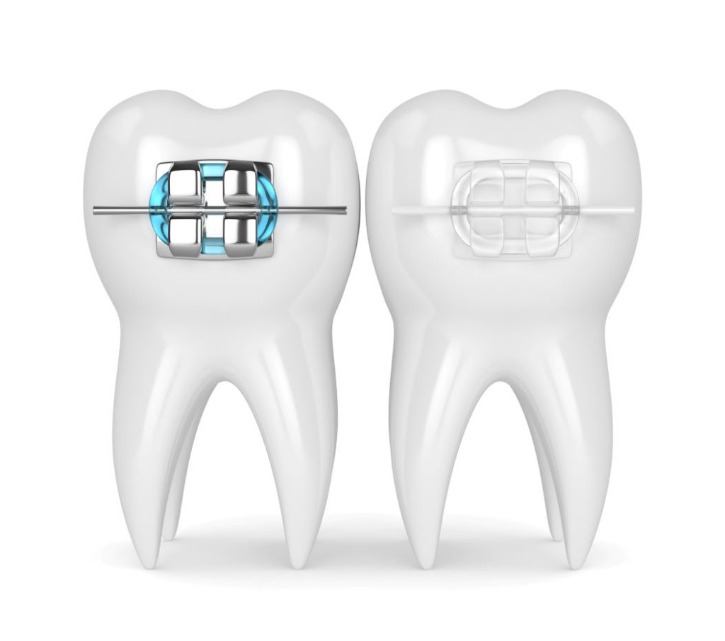 Concept image metal braces vs clear ceramic braces