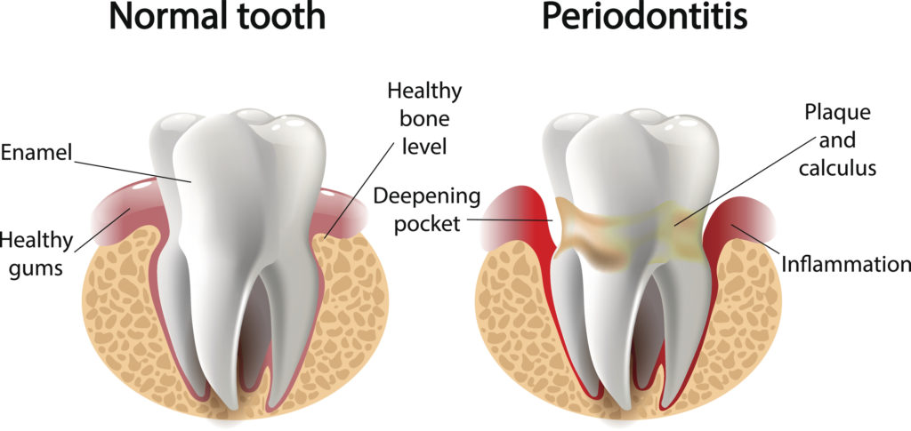 vector image tooth caries disease. Surface caries. Deep caries Pulpitis Periodontitis.