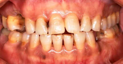 Discolored teeth as a result of methamphetamine use