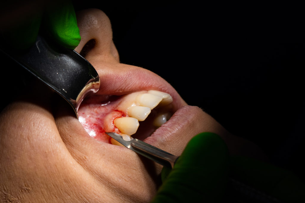 Dental intervention Perio surgery