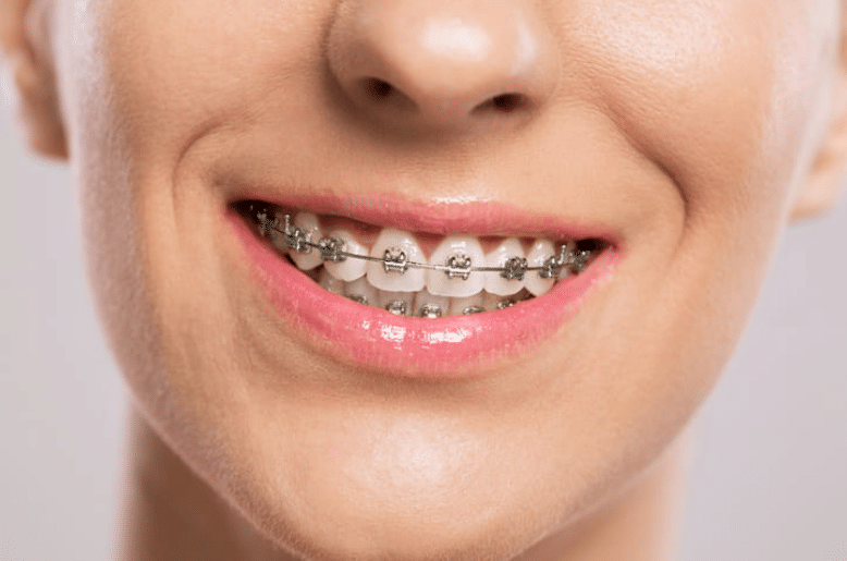 focus is on a person's mouth as they smile with braces.