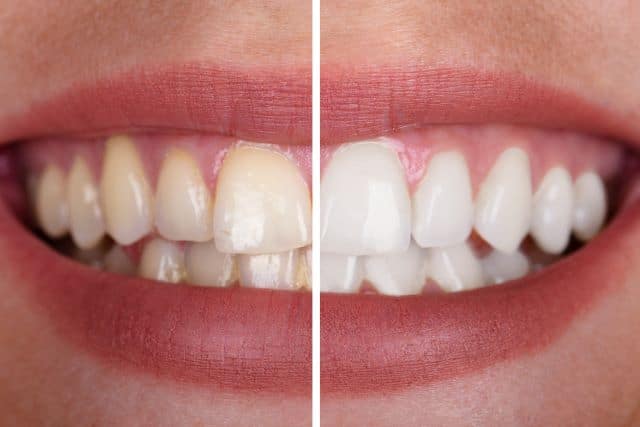 before and after teeth whitening تبيض اسنان في المنزل