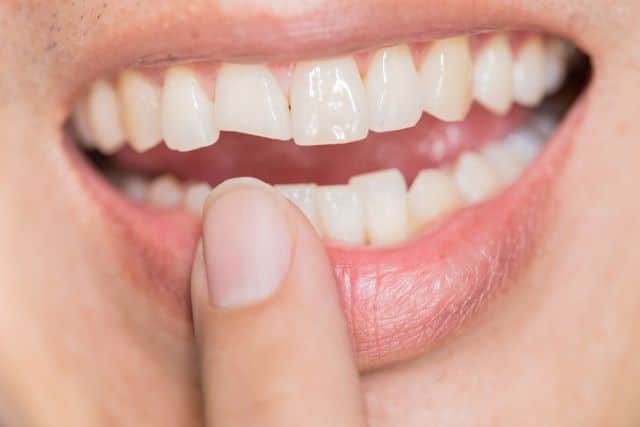 Male with a chipped tooth