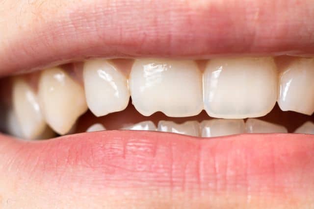 Chipped teeth due to seed shells